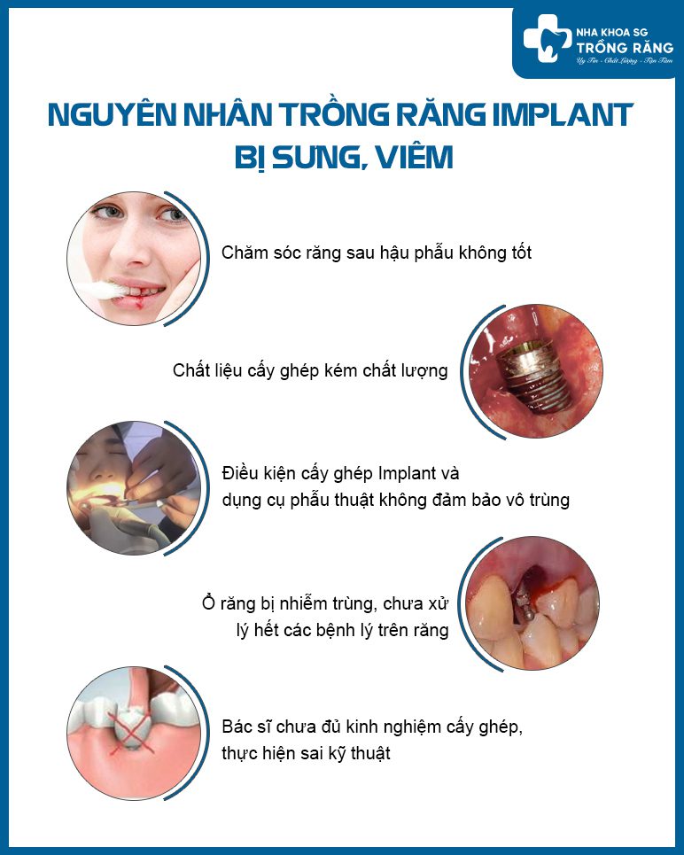 Nguyên nhân sau khi trồng răng Implant bị sưng mặt