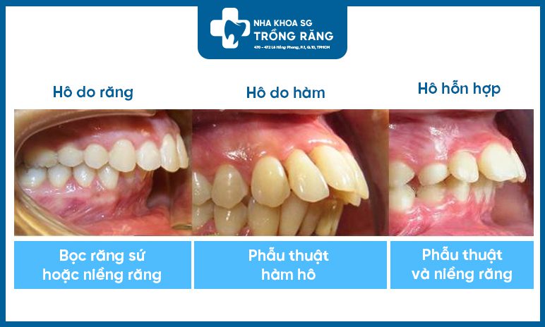 Phân biệt các dạng răng hô