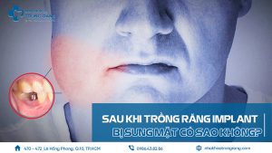 Sau khi trồng răng Implant bị sưng mặt