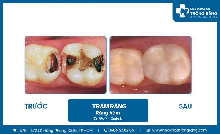 Trám răng hàm bị sâu lỗ to