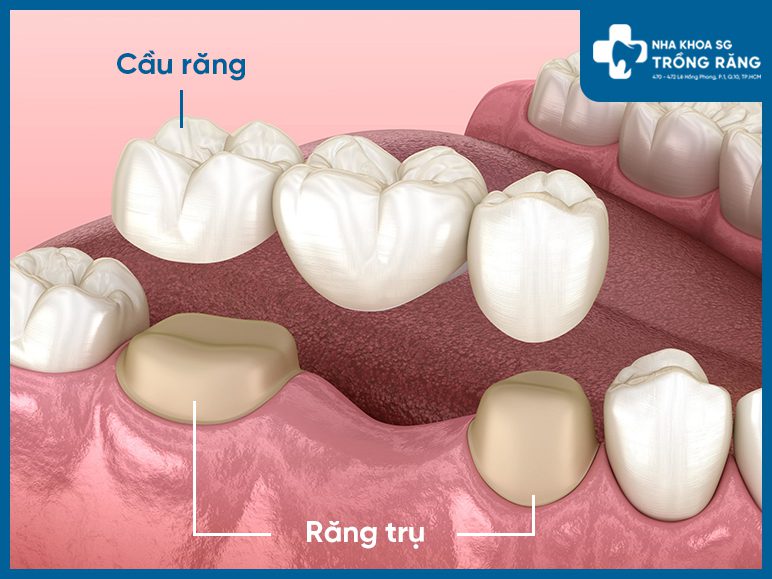 trồng răng hàm dưới bằng phương pháp bắc cầu răng