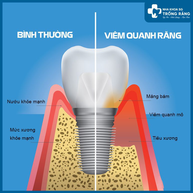 Viêm quanh răng Implant