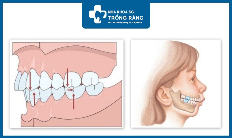 thế nào là răng hô