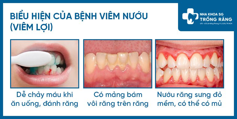 Bieu hien cua benh viem nuou Biểu hiện của bệnh viêm nướu