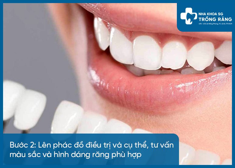 Buoc 2 quy trinh dan rang su Bước 2 quy trình dán răng sứ