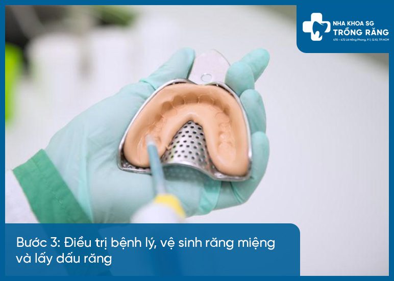 Buoc 3 quy trinh dan rang su Bước 3 quy trình dán răng sứ