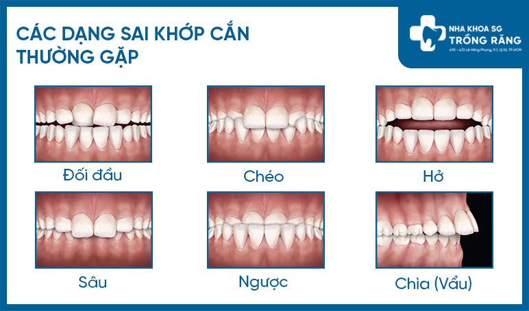 Các dạng sai khớp cắn thường gặp