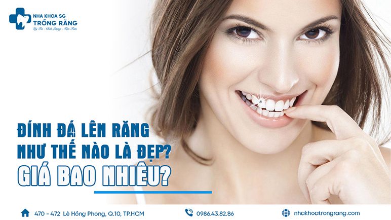 Đính đá lên răng giá bao nhiêu