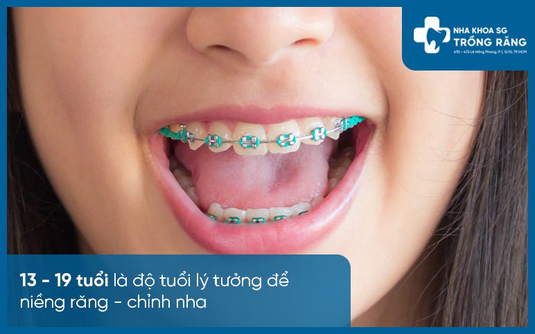 Độ tuổi lý tưởng để niềng răng