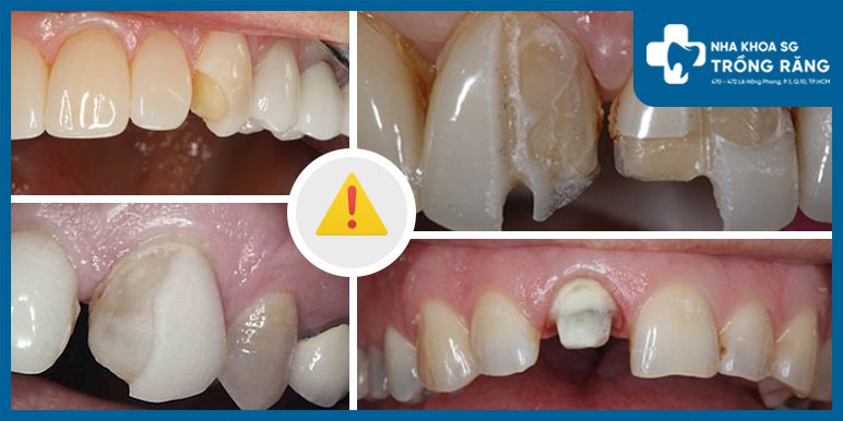 Hau qua Dan rang su sai ky thuat Hậu quả Dán răng sứ sai kỹ thuật