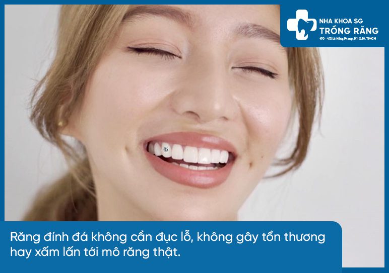 Hình ảnh đính đá lên răng