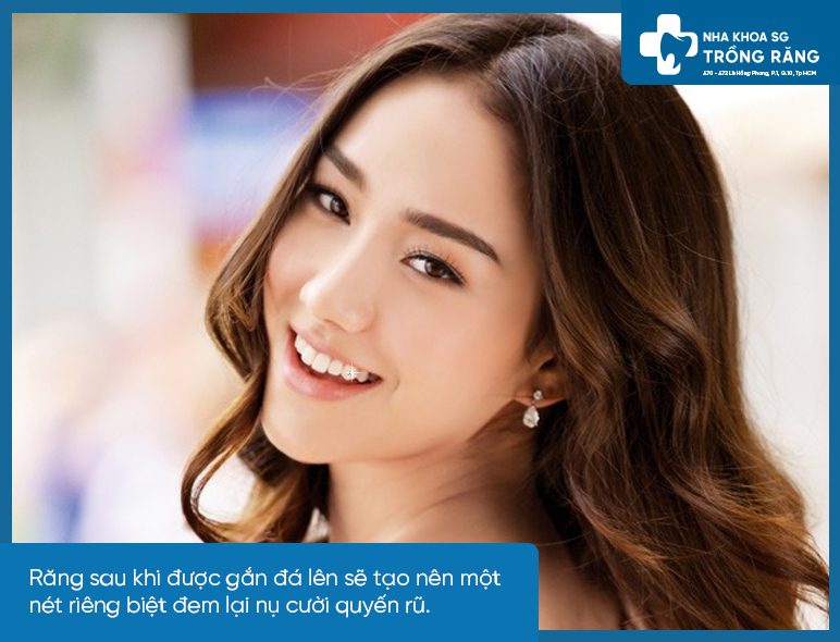 Lợi ích đính đá lên răng