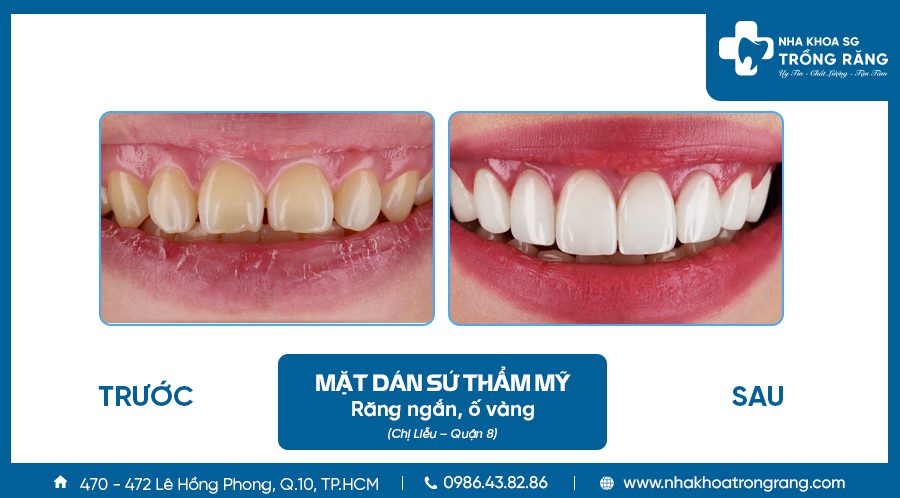 Mat dan rang su cho rang bi ngan Mặt dán răng sứ cho răng bị ngắn