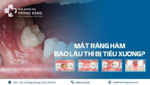 Mất răng bao lâu thì bị tiêu xương hàm