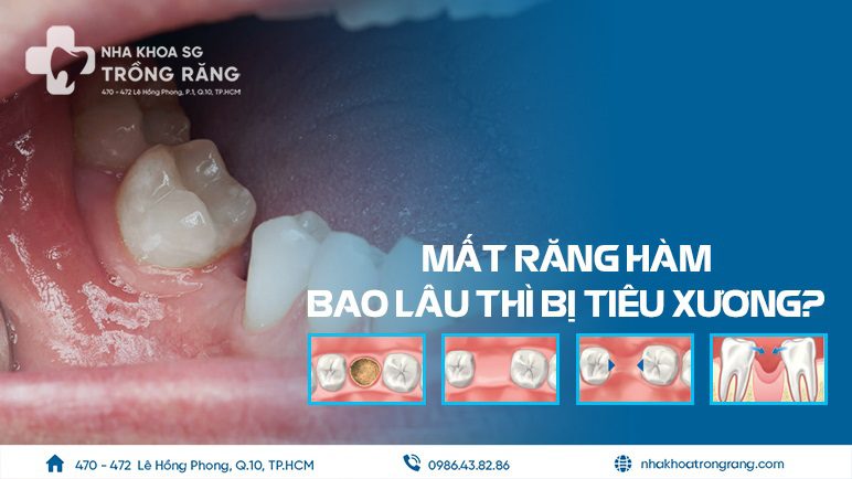 Mất răng bao lâu thì bị tiêu xương hàm