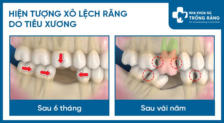 Mất răng gây xô lệch răng