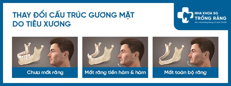Mất răng tiêu xương ảnh hưởng gương mặt