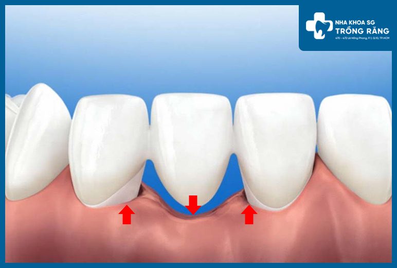 Mất răng tiêu xương hàm bên dưới cầu răng