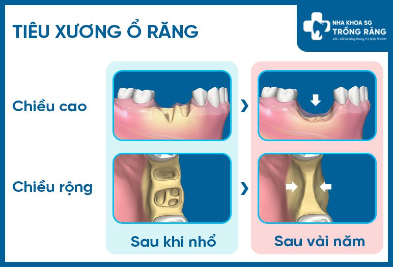 Mất răng tiêu xương hàm chiều dọc, chiều ngang