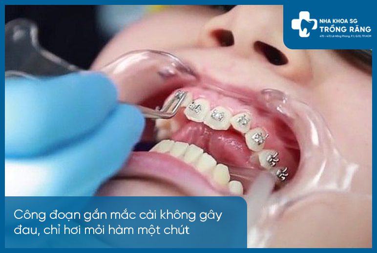 Niềng răng gắn mắc cài