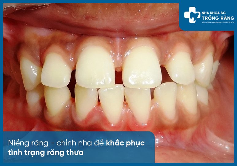 Niềng răng khắc phục thưa