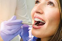 Niềng răng người lớn