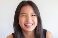 Niềng răng trẻ em