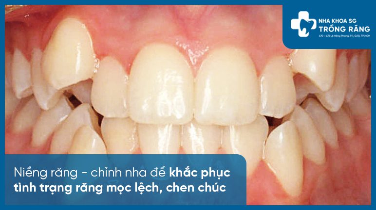 Răng mọc chen chúc