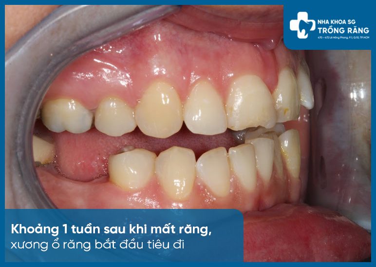 Thời điểm mất răng tiêu xương hàm ở nữ