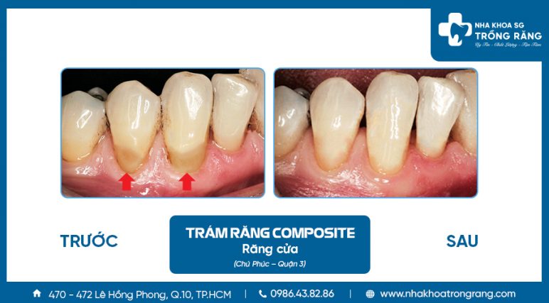 Trám răng mòn cổ