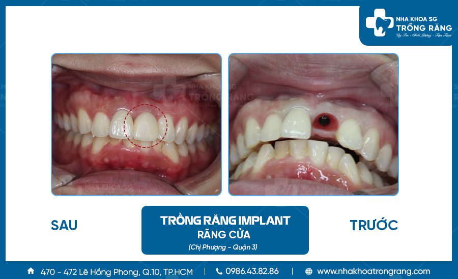 Trồng răng Implant tức thì kết hợp cấy ghép xương cùng lúc