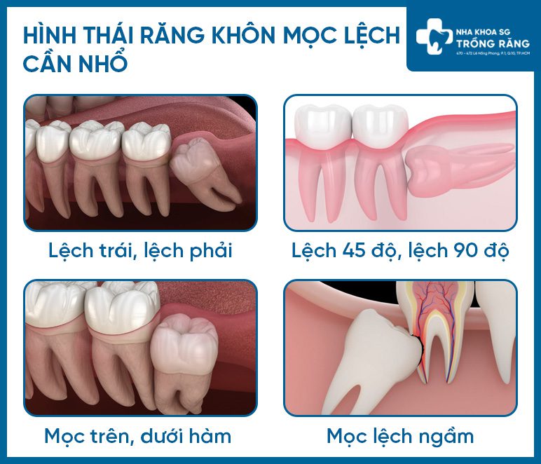 Các dạng mọc răng khôn