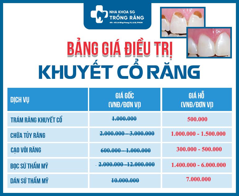 Chi phi dieu tri khuyet co rang moi