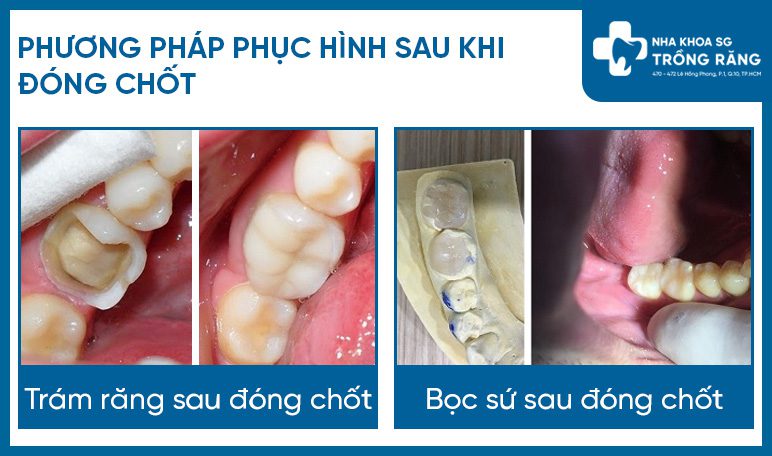 Đóng chốt răng và các phương pháp phục hình