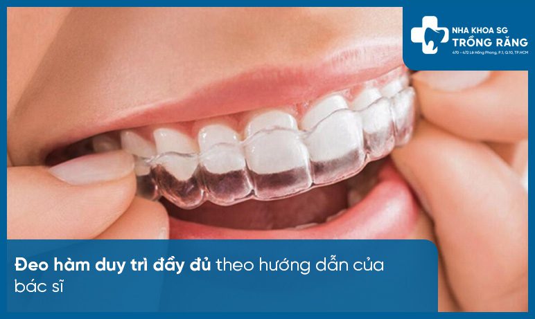 Hàm duy trì niềng răng