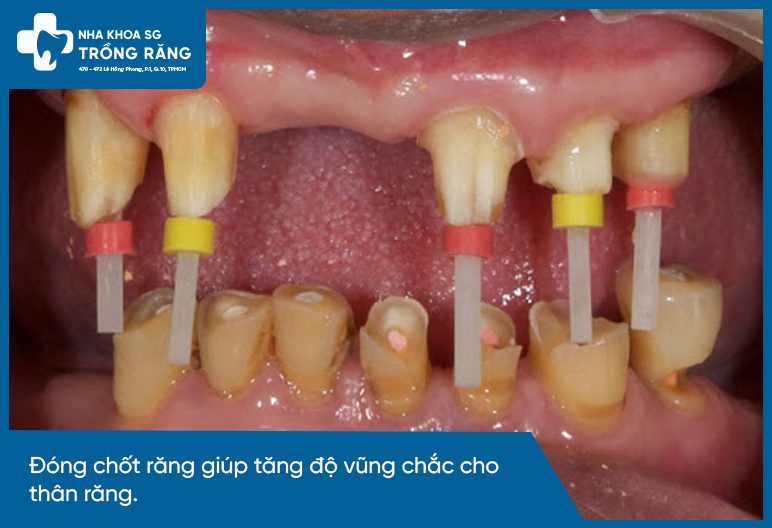 Hình ảnh đóng chốt răng sinh học