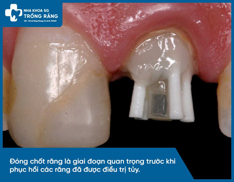 Hình ảnh đóng chốt răng