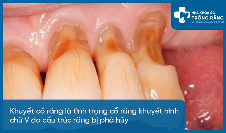 Hình ảnh khuyết cổ răng