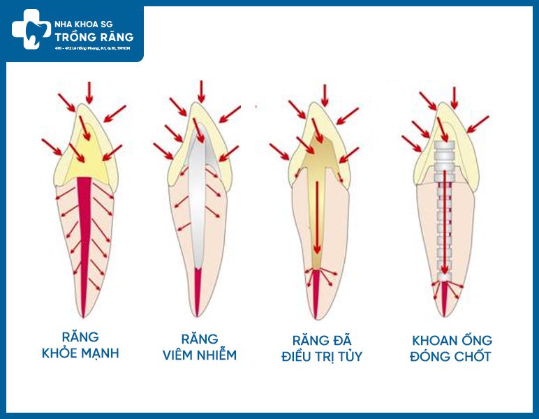 Hướng dẫn đóng chốt răng