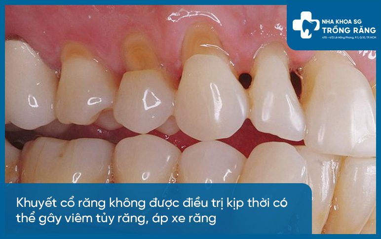 Khuyết cổ răng gây viêm tủy