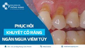 Khuyết cổ răng phục hồi