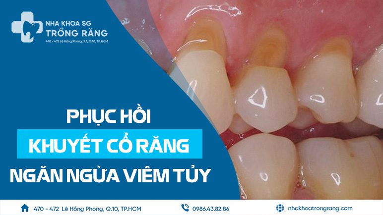 Khuyết cổ răng phục hồi