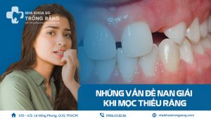 Mọc thiếu răng và vấn đề nan giải