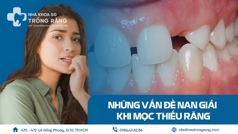 Mọc thiếu răng và vấn đề nan giải