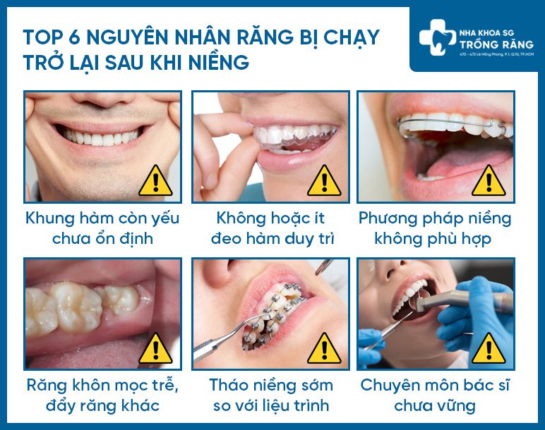 Mot so nguyen nhan nieng rang bi chay lai Một số nguyên nhân niềng răng bị chạy lại