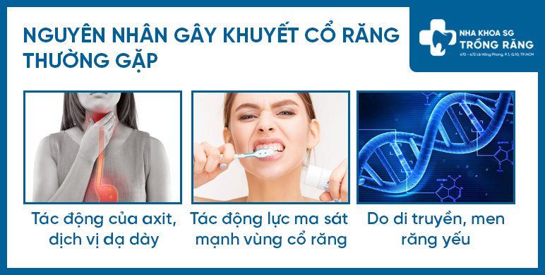 Nguyên nhân khuyết cổ răng