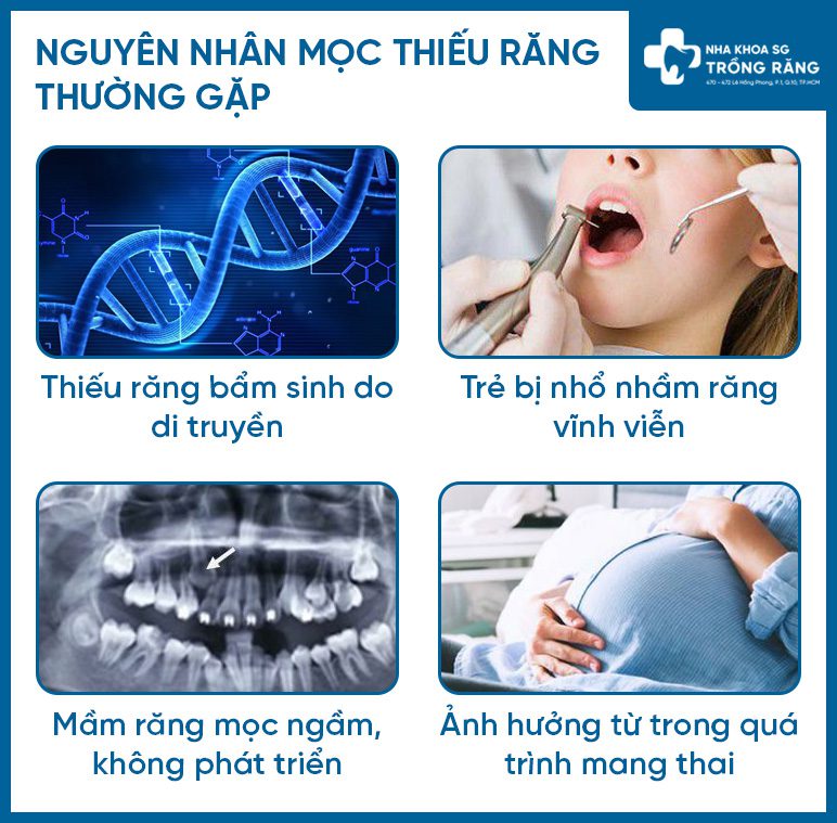 Nguyên nhân mọc thiếu răng