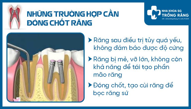Những trường hợp cần đóng chốt răng