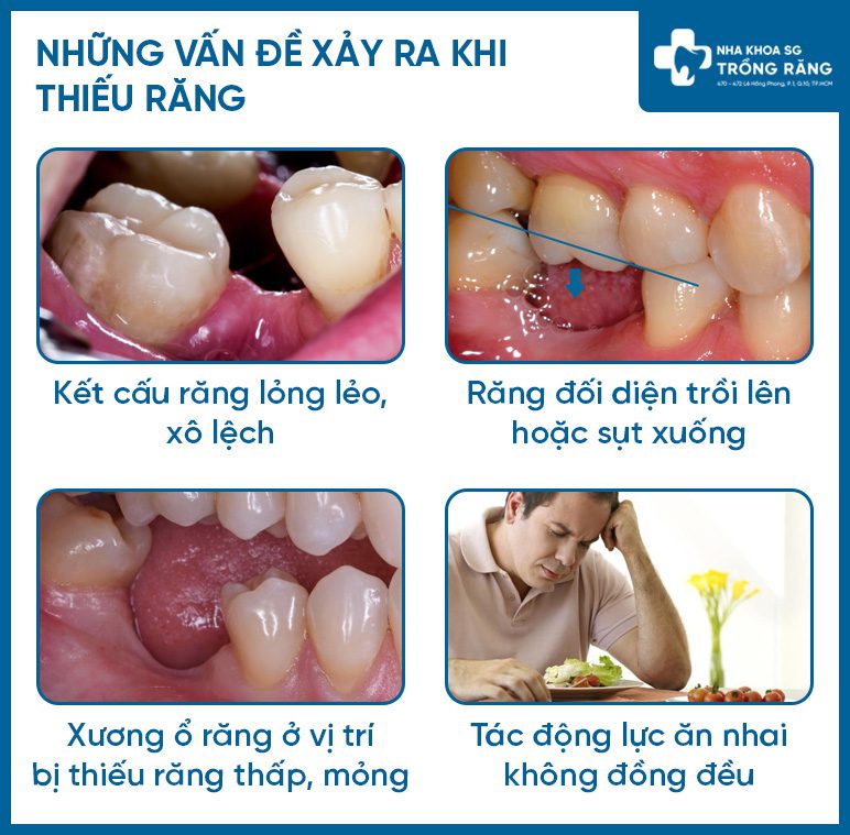 Những vấn đề khi mọc thiếu răng