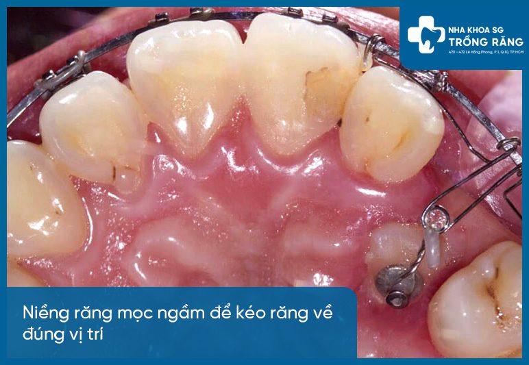 Niềng răng mọc ngầm để kéo răng
